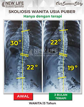 Terapi skoliosis Jakarta, Skoliosis wanita 13 tahun, sembuh skoliosis tanpa operasi, skoliosis 30 derajat jadi 22 derajat, Aurelia Christabel