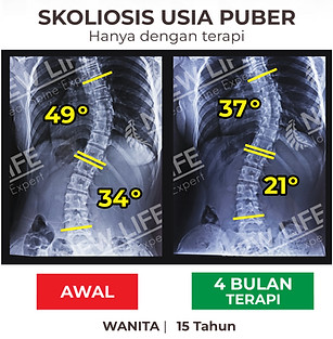Terapi Skoliosis Jakarta, Terapi Skoliosis Remaja Wanita, 49 derajat, menuju normal, menuju sembuh skoliosis
