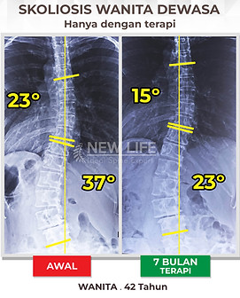 Terapi Skoliosis Jakarta, skoliosis dewasa 23 derajat ke 15 derajat hanya dengan terapi, skoliosis kurva S, skoliosis 37 derajat, skoliosis 23 derajat, turun derajatnya