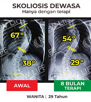 Terapi dan Latihan Skoliosis Jakarta, terapi skoliosis jakarta pria dewasa sembuh, normal skoliosis