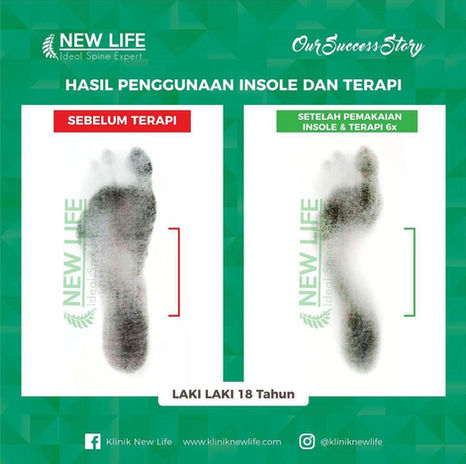 Terapi Kaki Bebek | Terapi Flat Foot