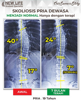 Terapi skoliosis Jakarta, Skoliosis pria 19 tahun, sembuh skoliosis tanpa operasi, skoliosis 17 derajat jadi normal, Made Wetan