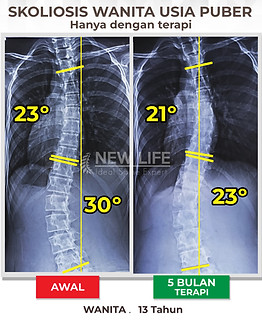 Terapi Skoliosis Jakarta, Terapi Skoliosis Remaja Wanita, 49 derajat, menuju normal, menuju sembuh skoliosis, skoliosis 23 derajat dan 30 derajat, 21 derajat, dan 23 derajat.
