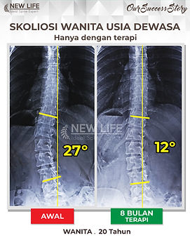 Terapi skoliosis Jakarta, Skoliosis perempuan, skoliosis wanita dewasa 20 tahun, sembuh skoliosis hanya dengan terapi, skoliosis 27 derajat jadi 12 derajat, Marfella Cory.jpg