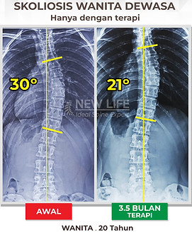 Terapi dan latihan skoliosis usia dewasa, skoliosis dewasa, skoliosis wanita, sembuh skoliosis