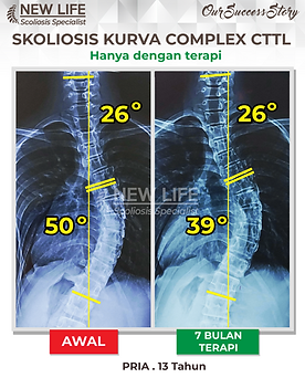 Terapi skoliosis Jakarta, skoliosis pria remaja 13 tahun, sembuh skoliosis tanpa operasi, skoliosis 50 derajat jadi 39 derajat, Rafa Ardhyan