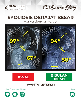 Terapi skoliosis Jakarta, Skoliosis wanita 23 tahun, sembuh skoliosis tanpa operasi, skoliosis 67 derajat jadi 50 derajat, Mifta Quljannah