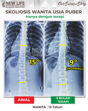 Terapi skoliosis Jakarta. Skoliosis Wanita Usia Puber
