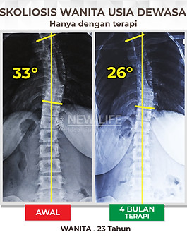 Terapi skoliosis jakarta, Terapi dan latihan skoliosis usia dewasa, skoliosis dewasa, skoliosis wanita, sembuh skoliosis, skoliosis 33 derajat, skoliosis 26 derajat, terapi skoliosis