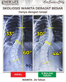 Terapi skoliosis Jakarta, Skoliosis wanita derajat besar, skoliosis wanita dewasa 24 tahun, sembuh skoliosis tanpa operasi, skoliosis 60 derajat jadi 44 derajat, Lisdiana Safitri