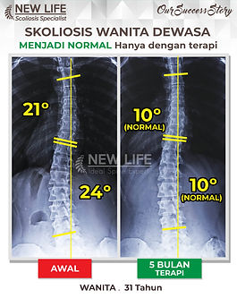 Terapi skoliosis Jakarta, Skoliosis wanita dewasa 31 tahun, sembuh skoliosis tanpa operasi, skoliosis 24 derajat jadi 10 derajat, Silviana Andry