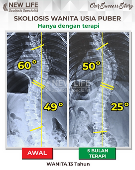 Terapi skoliosis Jakarta, skoliosis wanita puber 13 tahun, sembuh skoliosis tanpa operasi, skoliosis 49 derajat jadi 25 derajat, Jessie Crystal