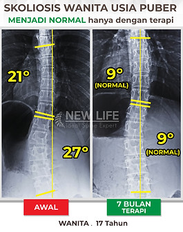 Terapi dan latihan skoliosis usia puber, skoliosis remaja, skoliosis wanita, sembuh skoliosis, 21 derajat ke 9 derajat dan 27 derajat ke 9 derajat