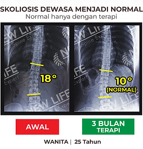 Terapi dan latihan skoliosis usia dewasa, skoliosis dewasa, skoliosis dewasa wanita, sembuh skoliosis, skoliosis