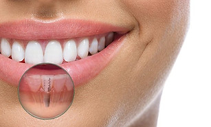 implante dentário.jpeg