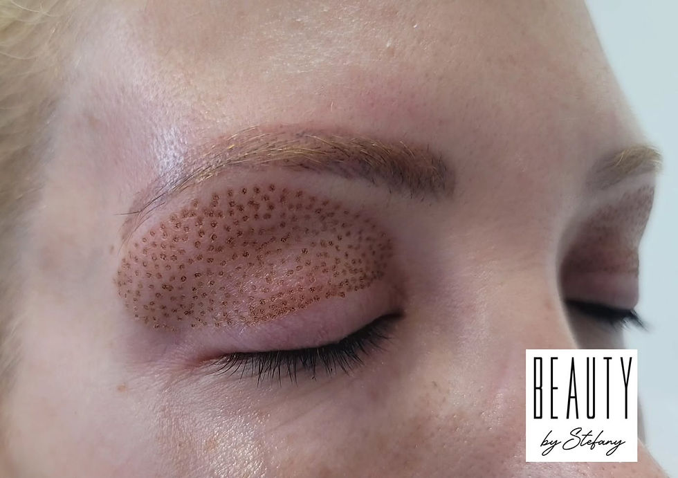 Post-treatment results showing the healing process on the eyelid with dotted marks, part of a cosmetic procedure by Beauty by Stefany.