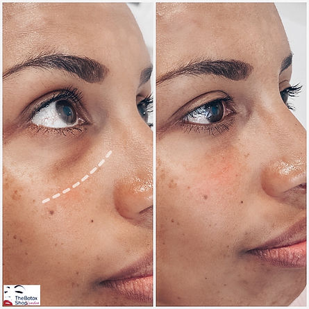 Tear trough filler The Botox Shop London.jpeg