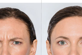 Botox Before & After