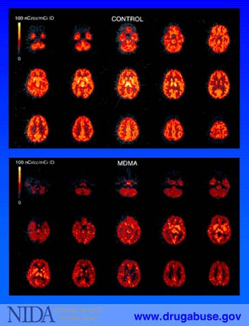 Brain Imaging, MDMA