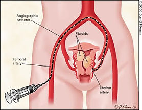 Uterine-Artery-Embolization-Against-Fibr