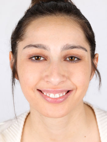 Primo piano di donna che sorride con sorriso naturale, esempio di risultato estetico Value a Milano