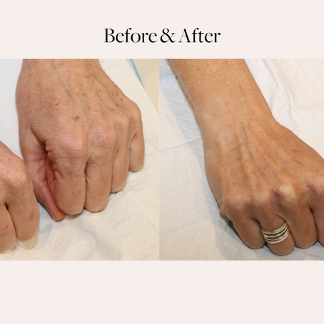 Reversing the Clock: Laser Rejuvenation for Sun Spots
