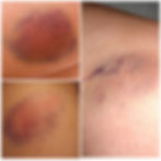 Las evidencias de un enemigo en mi cuerpo. (ALL) lymphoblastic leukemia