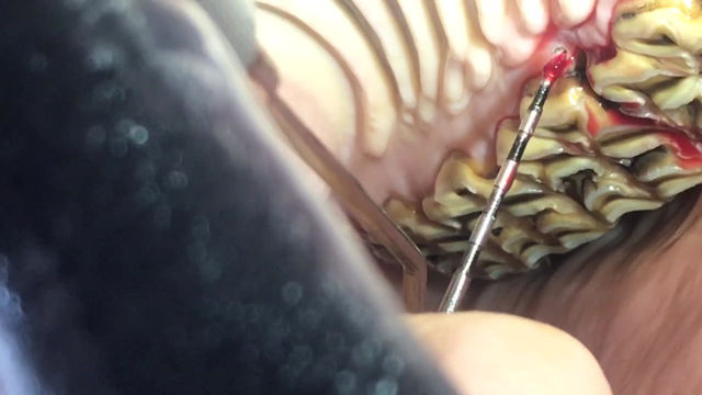 Thumbnail: Periodontal Dental Probe