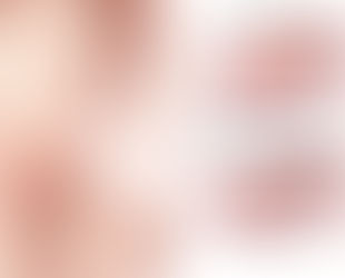 Síndrome dos ovários policísticos