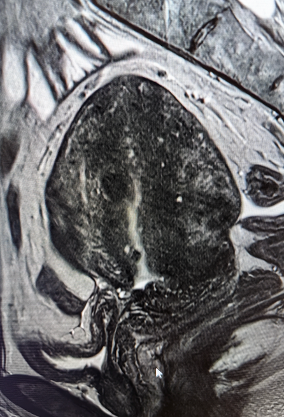 MR görüntülemede diffüz adenomyozis