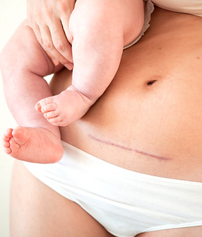 mom-s-abdomen-after-cesarean-section-scar-seam-young-mother-holds-baby-real-motherhood.jpg