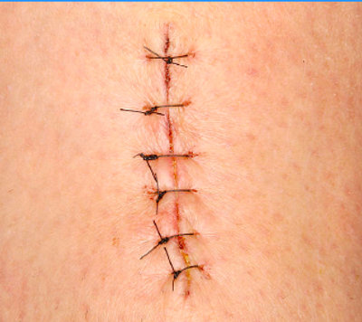 Stitches