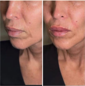 Soft PDO threads in the laugh-line/nasolabial area are typically done to:
* Stimulate collagen production over time
* Help soften the appearance of laugh lines
* Improve skin firmness and texture