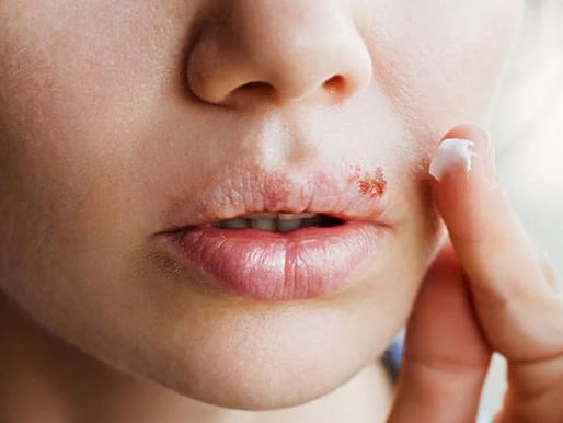 Del herpes labial a la demencia