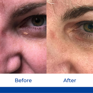 Xanthelasma.png