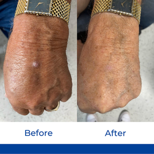 Wart-Like Lesions