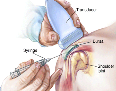 Ultrasound-guided-shoulder-Injection.gif