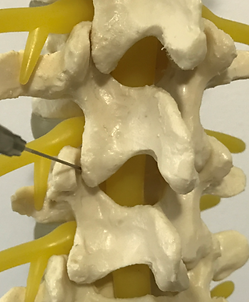 Facet Joint Injection | Facet Joint Pain | Spinal Injection