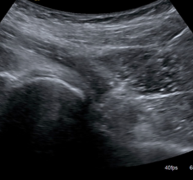 Ultrasound-Injection3.PNG