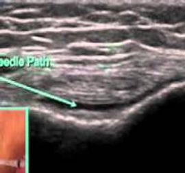 Ultrasound-Injection6.jpg