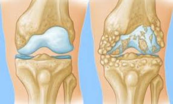 Knee Arthritis.jpg