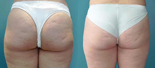 Pelleve, Radiofrequency,RF, Cellulite, Wrinkle reduction, Skin Tightening, Tuckahoe, Westchester, Bronx, Yonkers, Scarsdale, Bronxville, Eastchester, White Plains, Poughkeepsie, Dutchess, NY