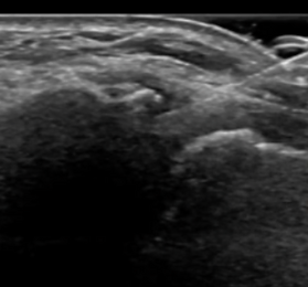 Ultrasound-Injection5.PNG