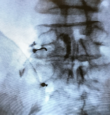 Transforaminal epidural steroid injection, ESI, Spine Injection,Tuckahoe, Bronxville, Eastchester, Scardale, Westchester, Poughkeepsie, Hyde Park, Highland, Wappingers Falls, Dutchess, NYC, NY