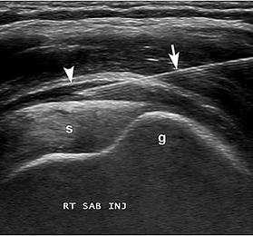 Ultrasound-Injection2.png