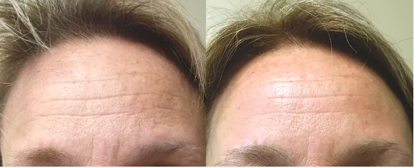 Pelleve, Radiofrequency,RF, Cellulite, Wrinkle reduction, Skin Tightening, Tuckahoe, Westchester, Bronx, Yonkers, Scarsdale, Bronxville, Eastchester, White Plains, Poughkeepsie, Dutchess, NY