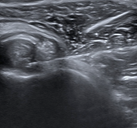 Ultrasound-Injection4.PNG