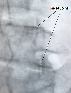 Facet Joint Injection, Facet Joint Pain, Facet arthropathy