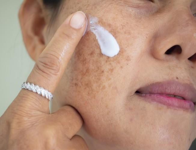 Tratamiento melasma