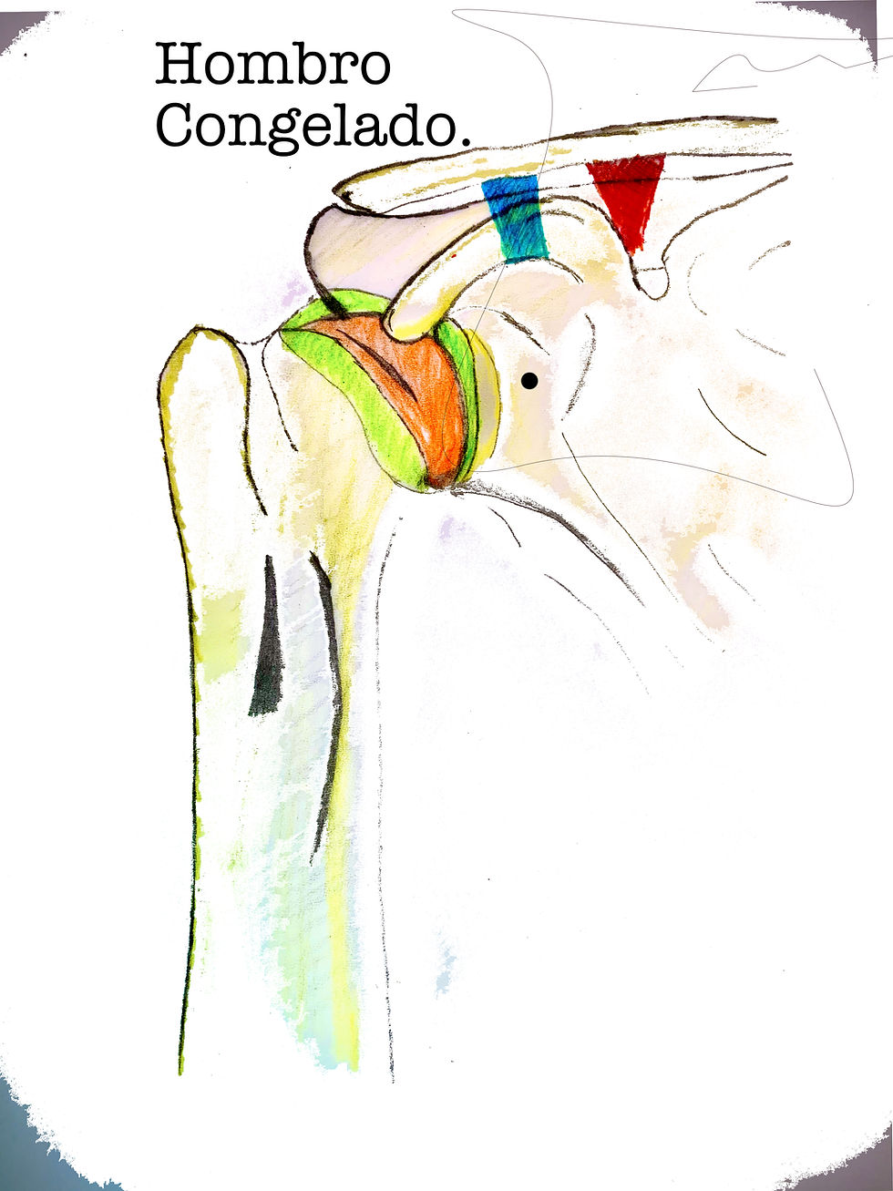 Hombro congelado. ¿Qué es y como se trata?